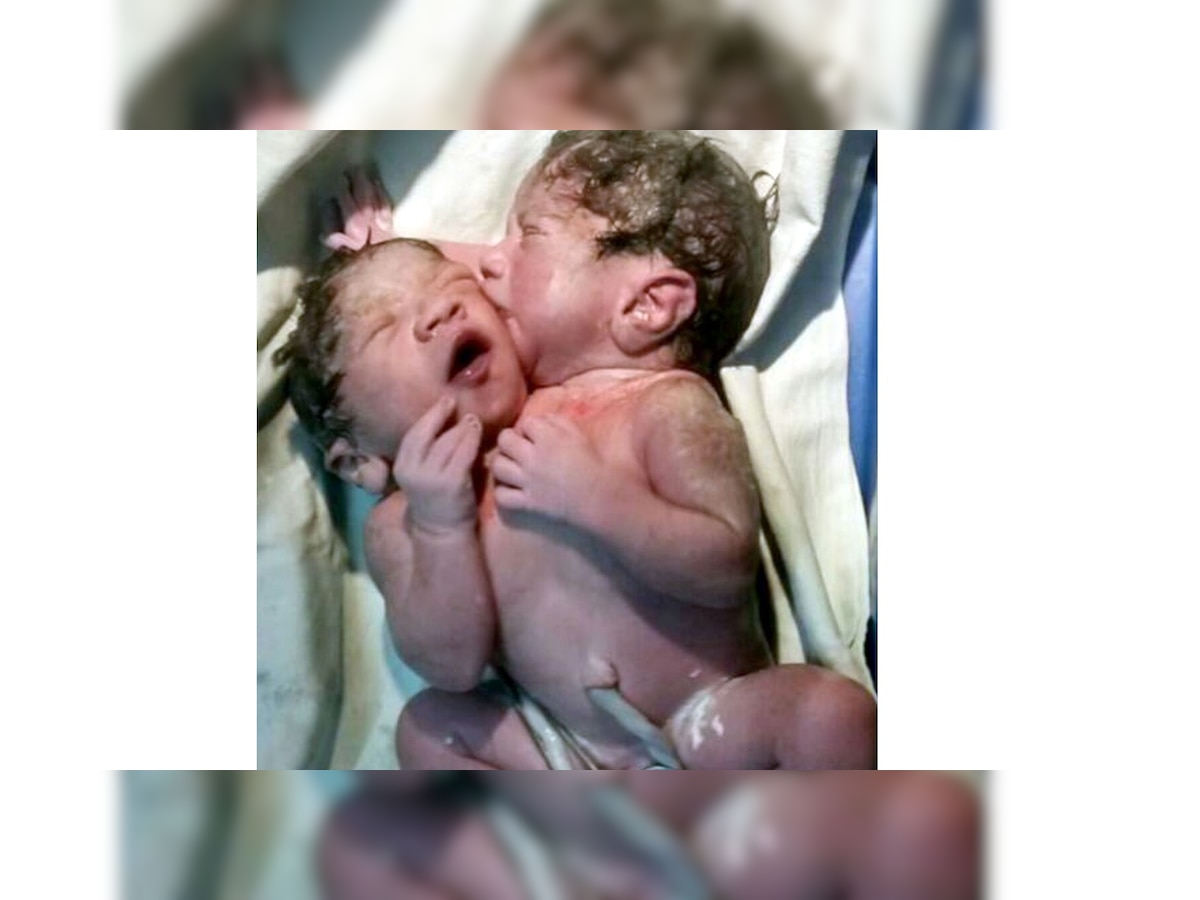 सायन रुग्णालयामध्ये दोन तोंडाच्या बाळाचा जन्म... title=