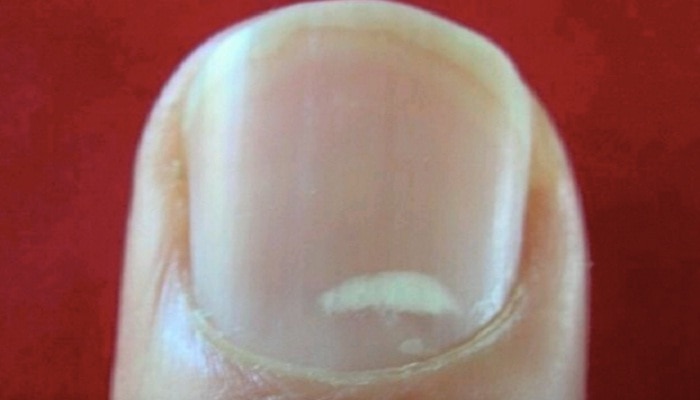 What White Marks on Nails Mean About Health