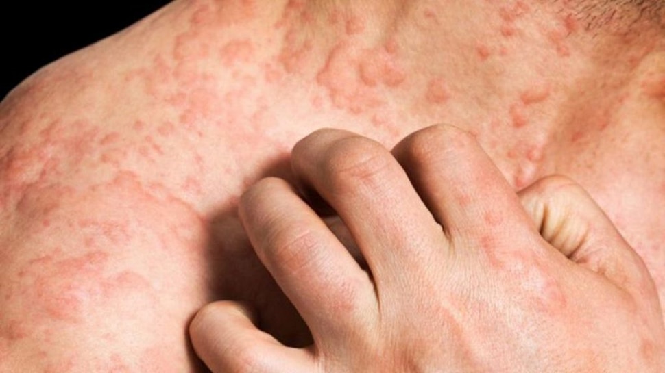 'हा' भयंकर त्वचारोग तुम्हाला तर नाही ना? I skin diseases