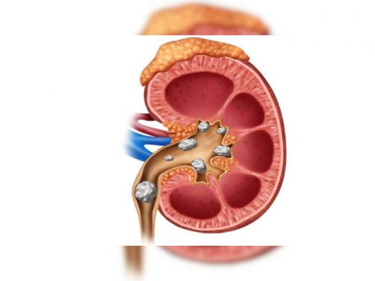 किडनी स्टोनची समस्या गंभीर करतील हे ६ पदार्थ! title=