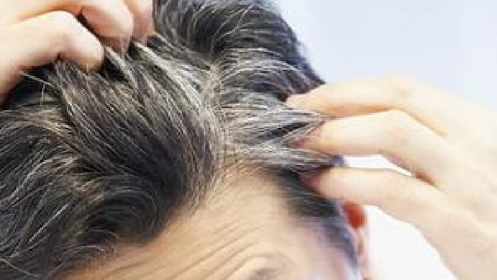 कस गळण थबवणयसठ उपय  Hair Loss Remedies and Treatment Explained in  Marathi