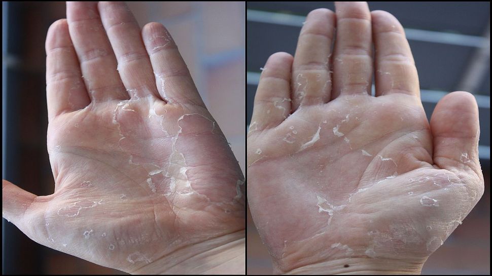 Peau Du Gland Qui Pele Et Odeur स्किन पिलिंगच्या समस्येवर रामबाण नैसर्गिक उपाय । How to get rid Of Skin