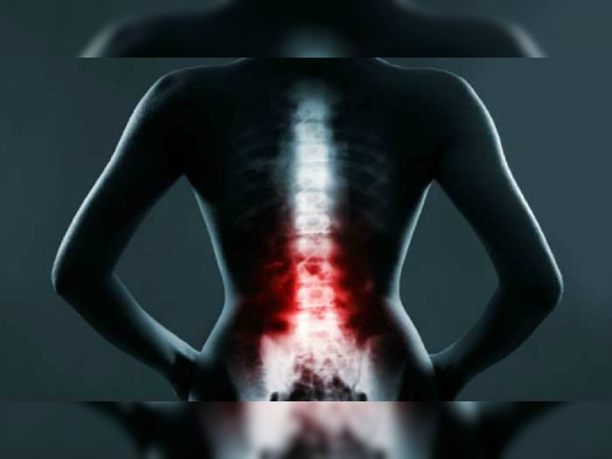 Ankylosing Spondylitis:कमरेचे किरकोळ दुखणे दुर्लक्षित करू नका  title=