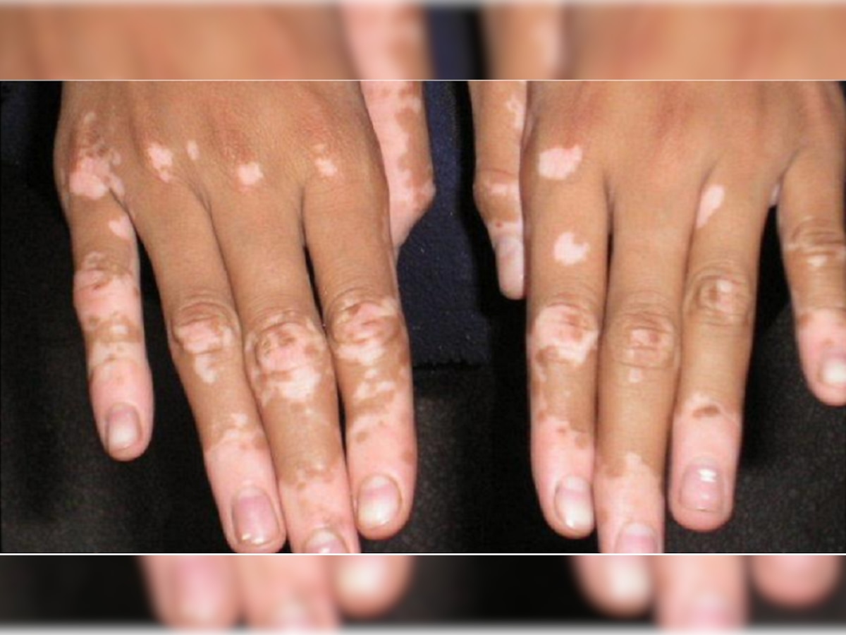 World Vitiligo Day: पांढऱ्या कोडावर उपचार होवू शकतात title=