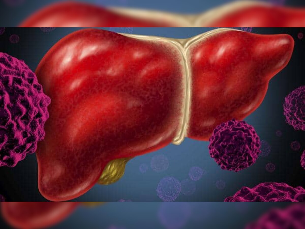 फॅटी लिव्हर आजार बनतेय धोक्याची घंटा, जाणून घ्या  title=