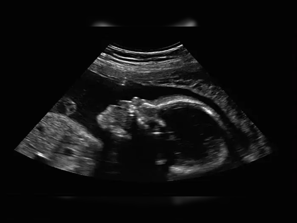 आईचा गर्भ बाळाच्या पोटात; १८ महिन्याच्या बाळाची गुंतागुंतीची शस्त्रक्रिया  title=