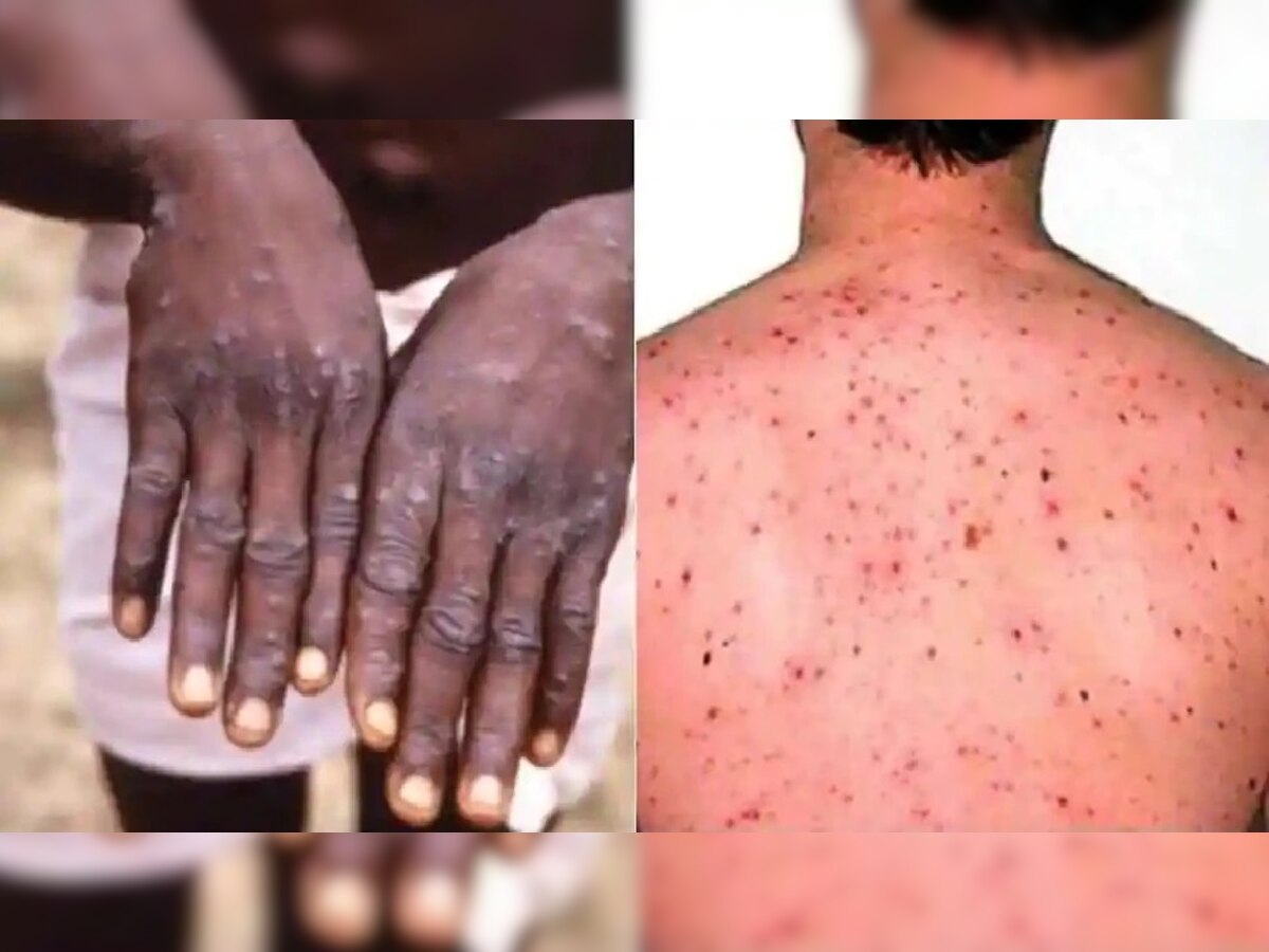 आधीच कोरोनाने बेजार, त्यात आता 18 वर्षांपूर्वीचा आजार, काय आहे Monkeypox? जाणून घ्या लक्षणं title=