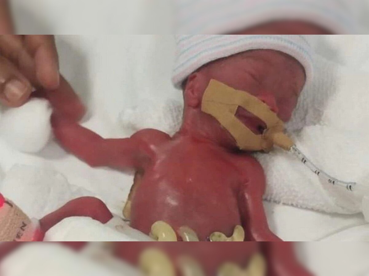 जगातील सर्वात लहान Premature Baby, जन्माच्यावेळी अवघं 212 ग्रॅम वजन title=