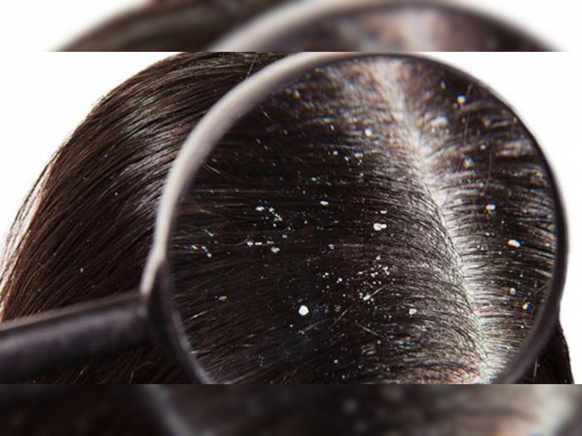 Dandruff treatment : डोक्यातील कोंडा दूर करण्यासाठी घरगुती उपाय title=