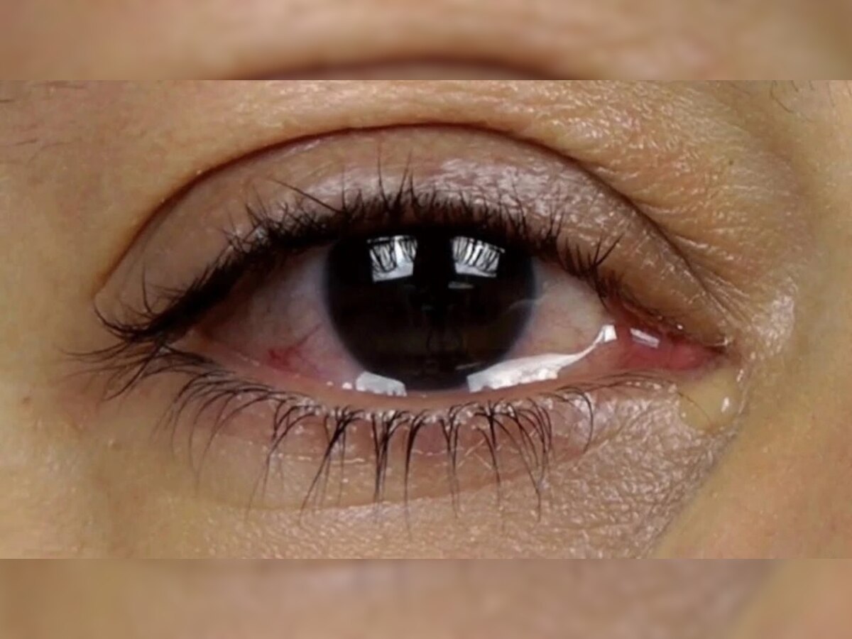 Eye Care: तुमच्या डोळ्यातून ही सारखं पाणी येतं का? तर ही गोष्ट केली पाहिजे title=