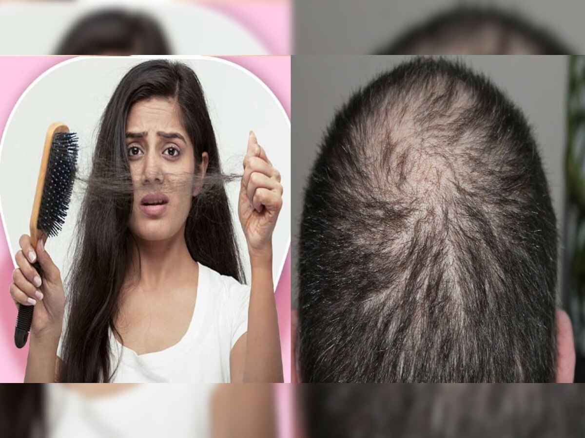 Reason of hair loss: या ५ कारणांमुळे गळतात केस, अशी रोखू शकता केस गळती title=