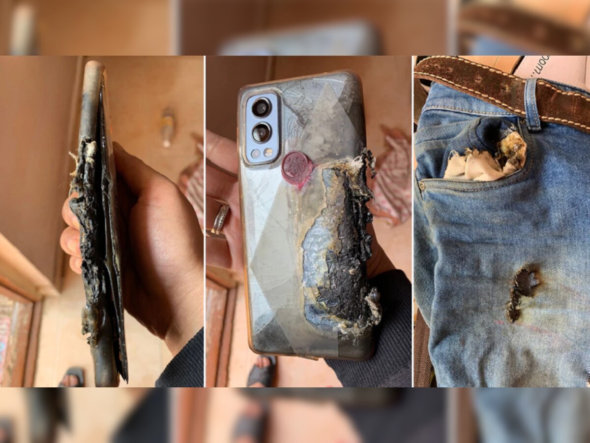 OnePlusचा पॅन्टच्या खिशात स्फोट, या व्यक्तीची काय अवस्था झाली पाहा फोटो title=