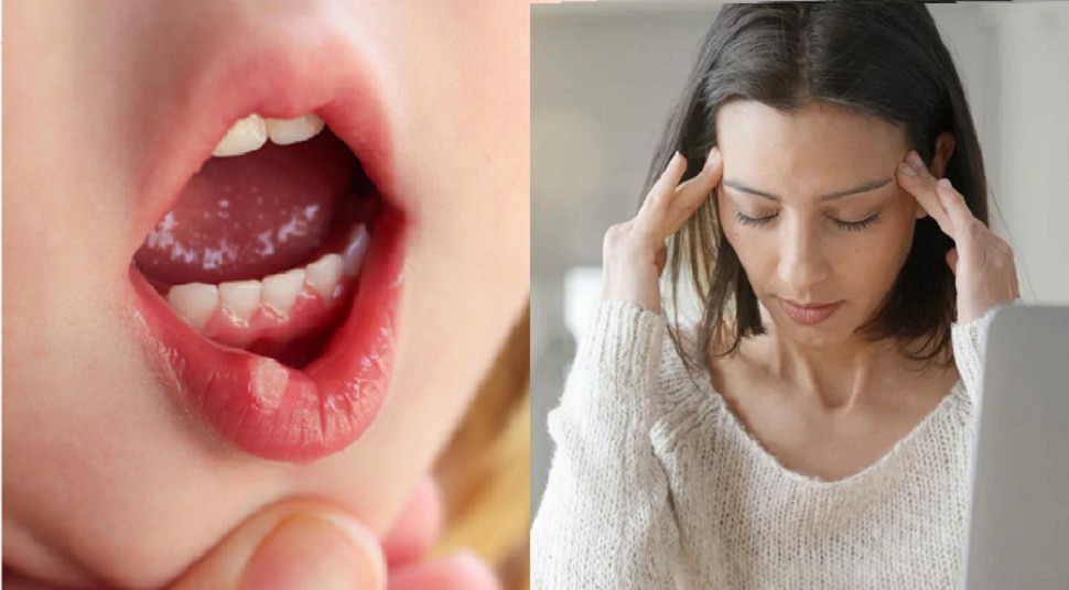 vitaminb12deficiencyreasonofheadacheandtongueblisters