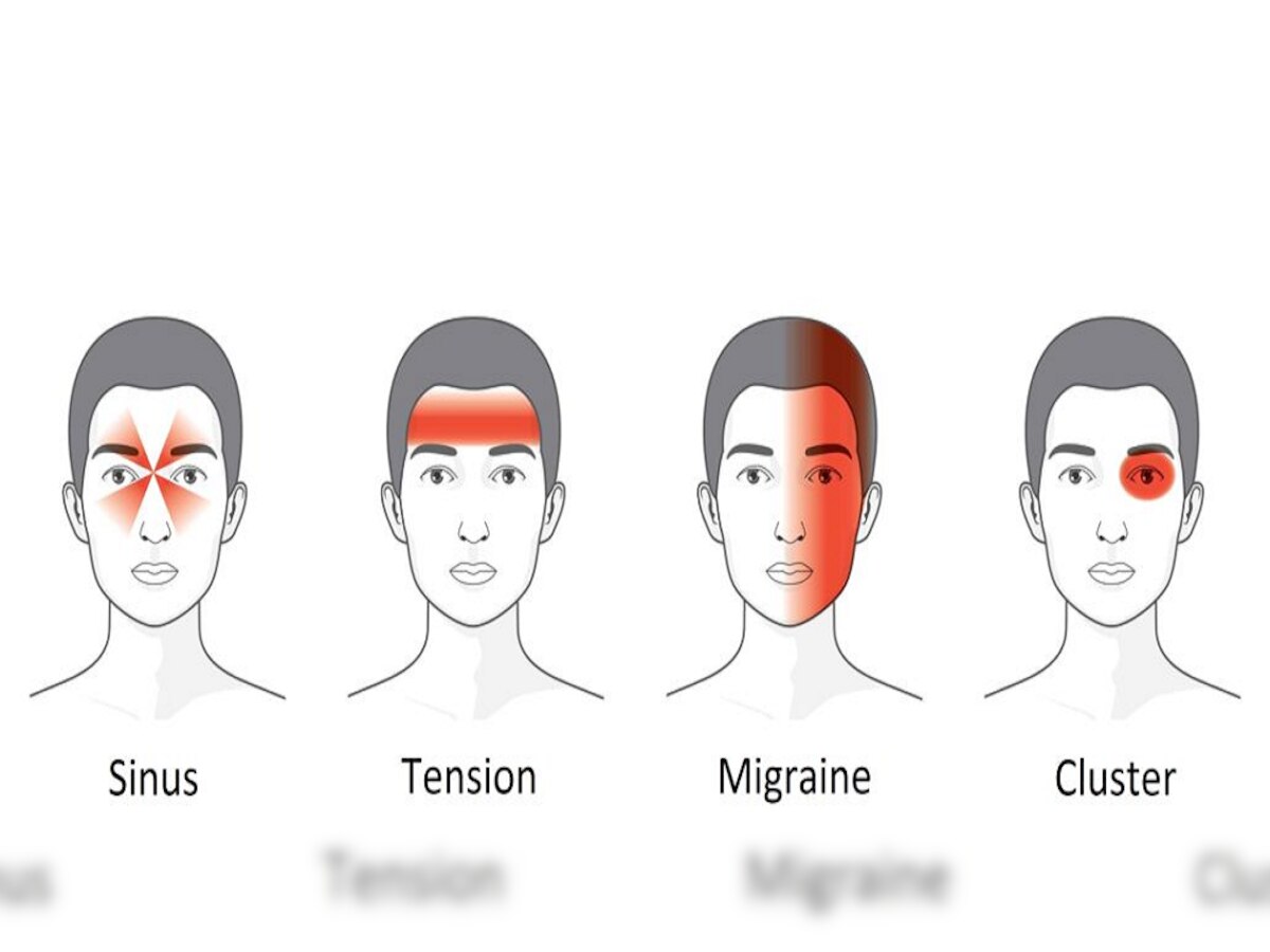 डोकेदुखीचे 4 प्रकार आहेत, यातील तुम्हाला होणारी डोकेदुखी कोणत्या प्रकारची? जाणून घ्या title=