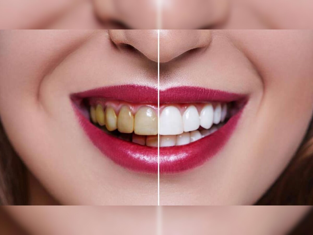 Teeth Cleaning: 'या' घरगुती उपयांनी दात होतील मोत्यासारखे पांढरे शुभ्र title=