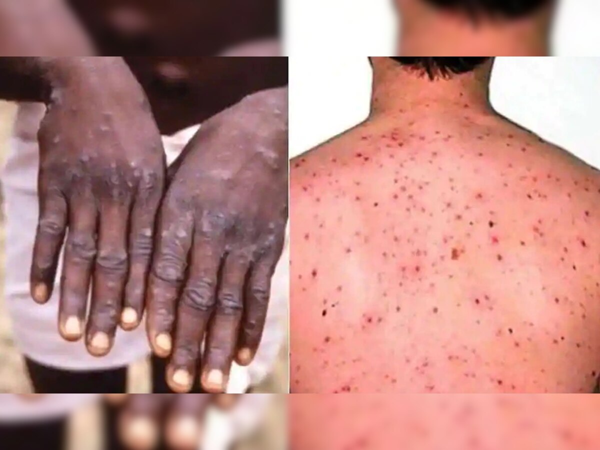 लैंगिक संबंधांमुळे पसरतोय Monkeypox? आरोग्य तज्ज्ञांचा सूचक इशारा title=