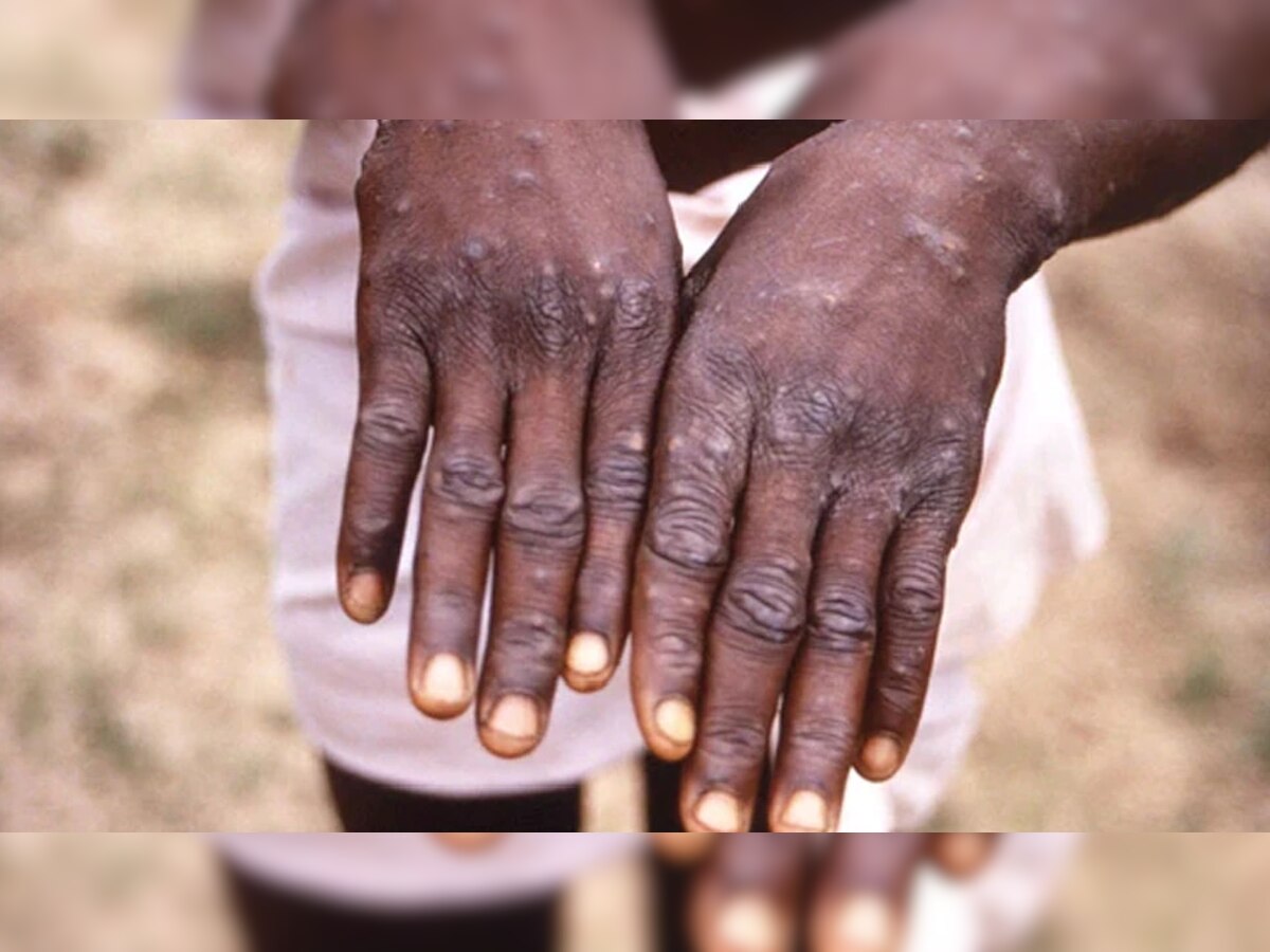 Monkeypox च्या रूग्णसंख्येचा आलेख वाढताच; WHO ची आपात्कालीन बैठक title=