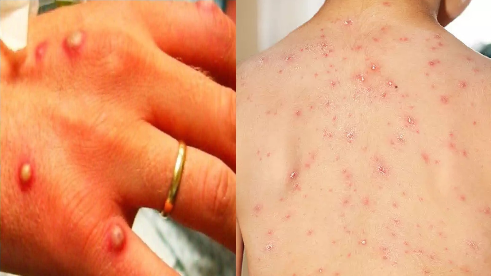 difference-between-monkeypox-and-chicken-pox