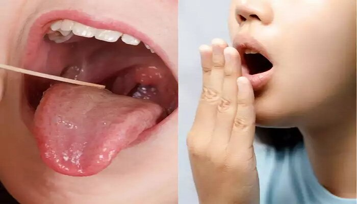 home-remedies-for-tooth-nerve-pain