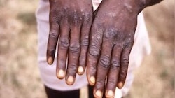 WHN कडून Monkeypox मुळे महामारी घोषित; यामुळे धोका कायम, जाणून घ्या माहिती