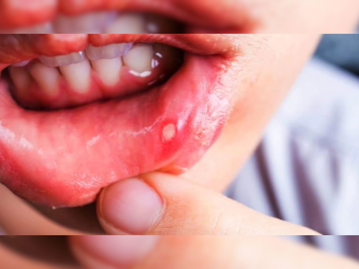 Mouth Ulcers : तुम्ही देखील तोंड येण्याच्या समस्येनं त्रस्त आहात? मग 'हा' उपाय नक्की करुन पाहा title=