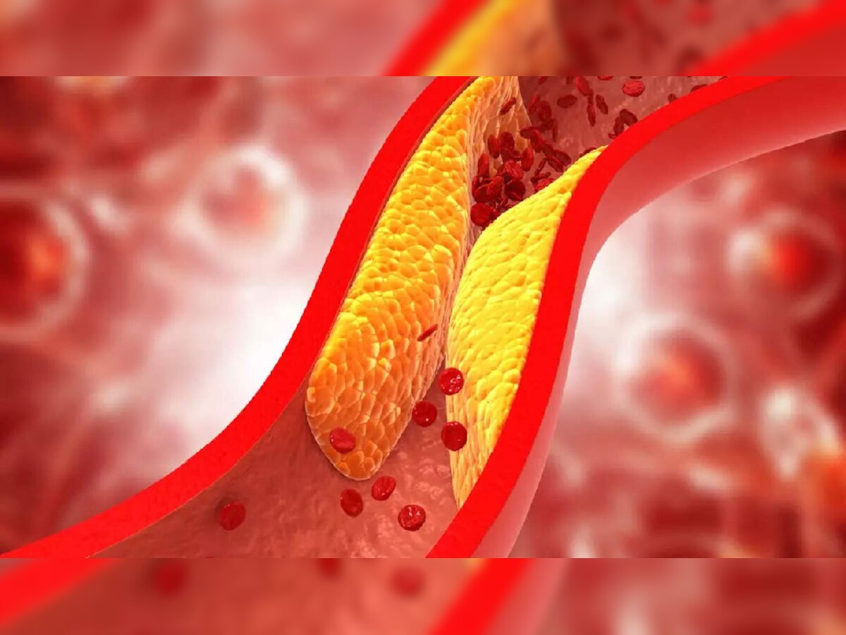 Cholesterol नैसर्गिक पद्धतीने कमी करण्याचे 5 रामबाण उपाय title=