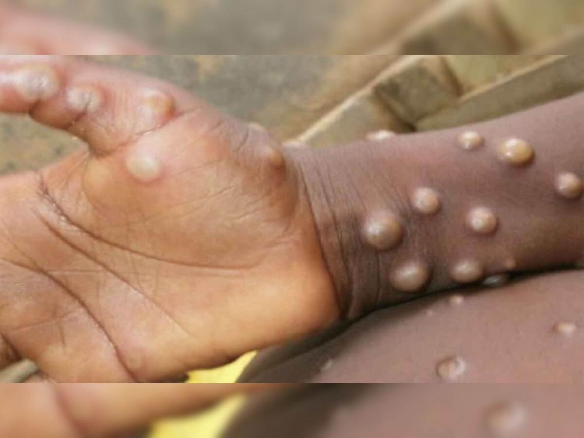 देशातील 'या' राज्यात सापडला Monkeypox चा पहिला रुग्ण?  title=