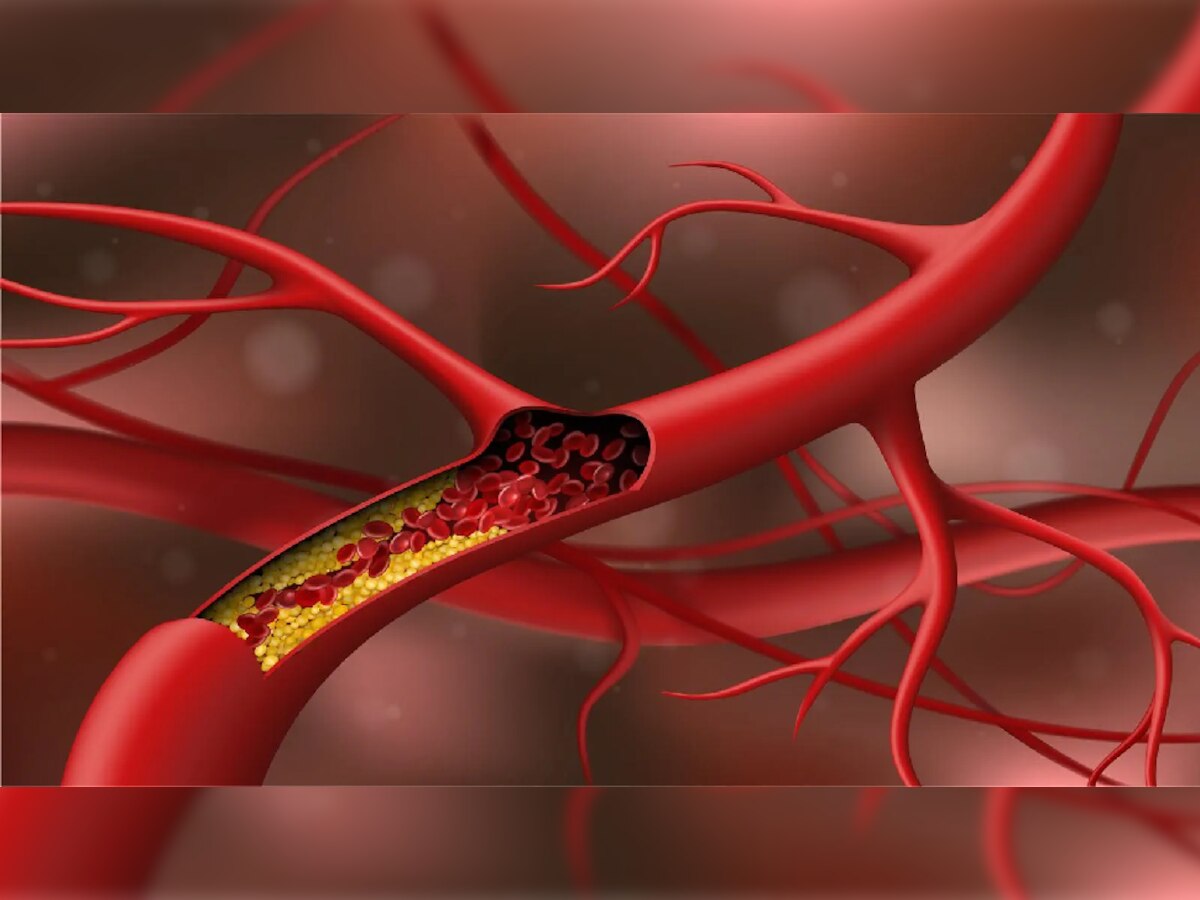 तुमच्या दररोजच्या 'या' 3 सवयी वाढवतायत तुमची Cholesterol लेवल title=