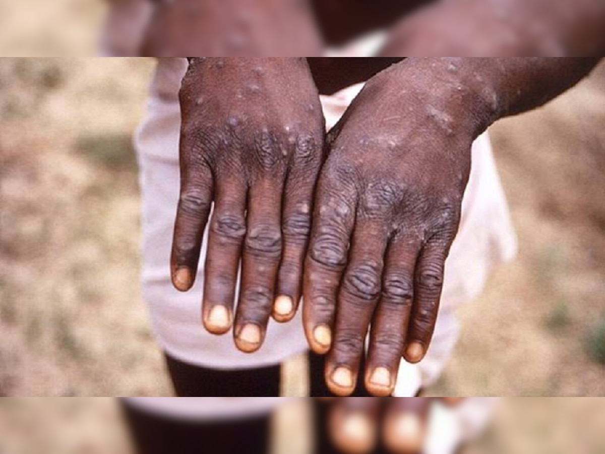 Monkeypox : मंकीपॉक्सचा धोका, केंद्र सरकार अलर्ट मोडवर, राज्यांना केल्या या सूचना title=