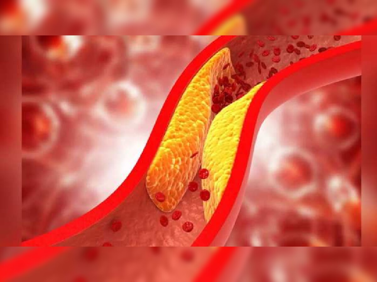 आता Cholesterol ला अजिबात घाबरू नका; 'या' गोष्टींनी कमी होईल खराब कोलेस्ट्रॉल title=