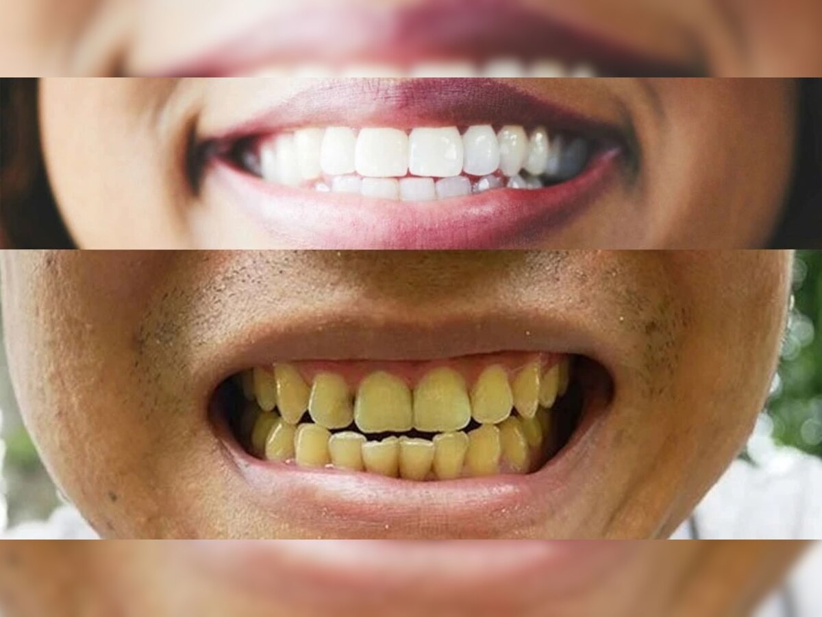 Teeth Whitening: तुमचे दात पिवळे पडलेत? घरातील फळांनी कराल मोत्यासारखे स्वच्छ title=