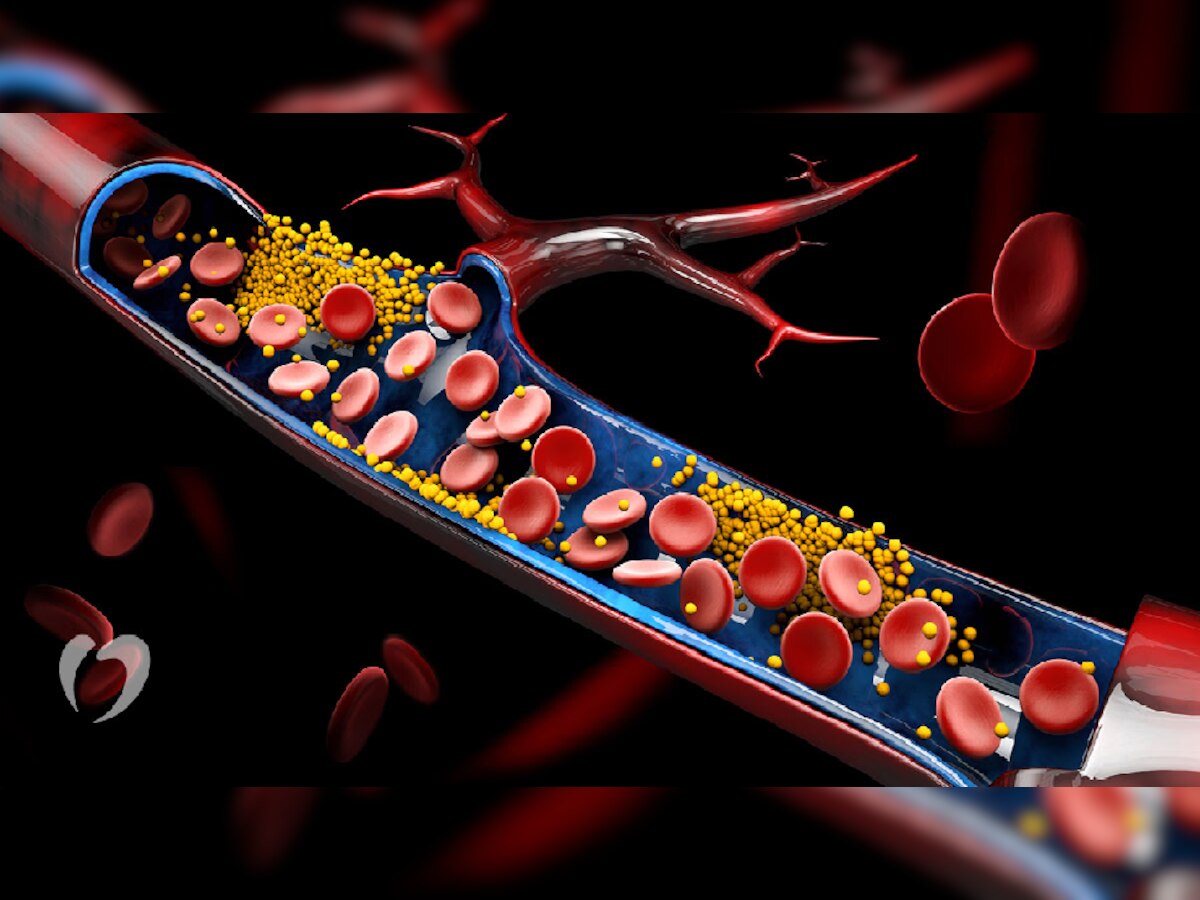 शरीरात अचानक Cholesterol वाढवू शकतात 'या' गोष्टी; आजच दूर करा title=