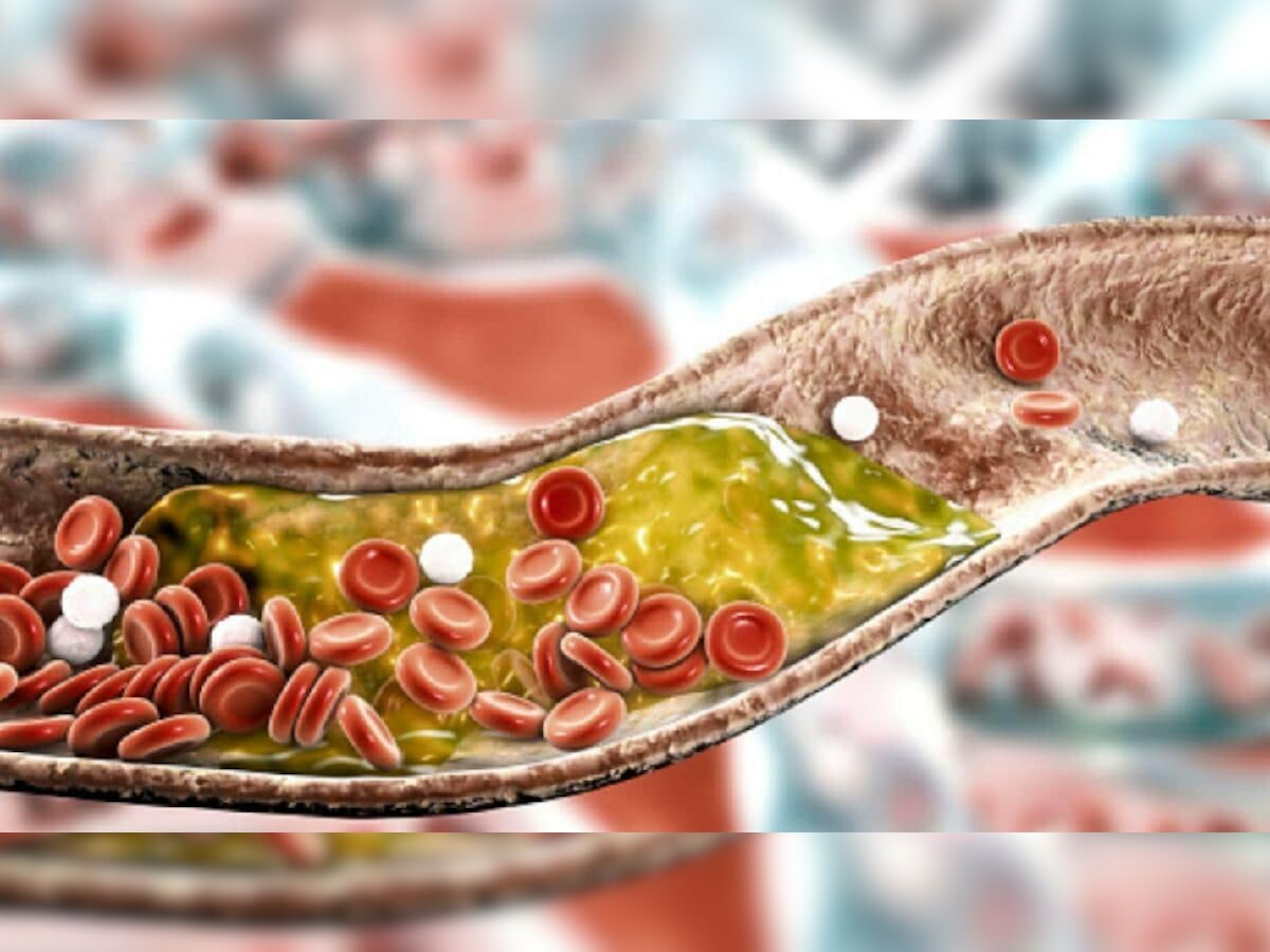 रक्तात जमा असलेलं Cholesterol कमी करतील तुमच्या किचनमध्ये असलेल्या गोष्टी! title=