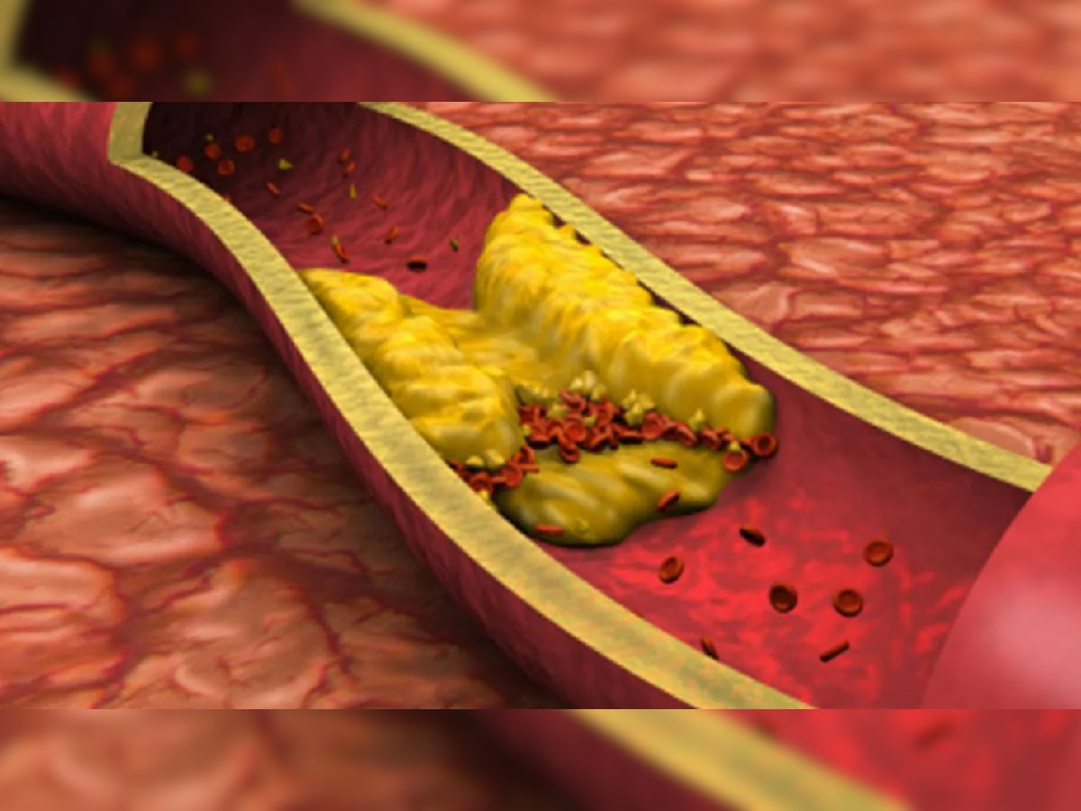 High cholesterol: शरीराच्या 'या' भागाची त्वचा कोरडी पडलीये? cholesterol वाढण्याचे संकेत title=