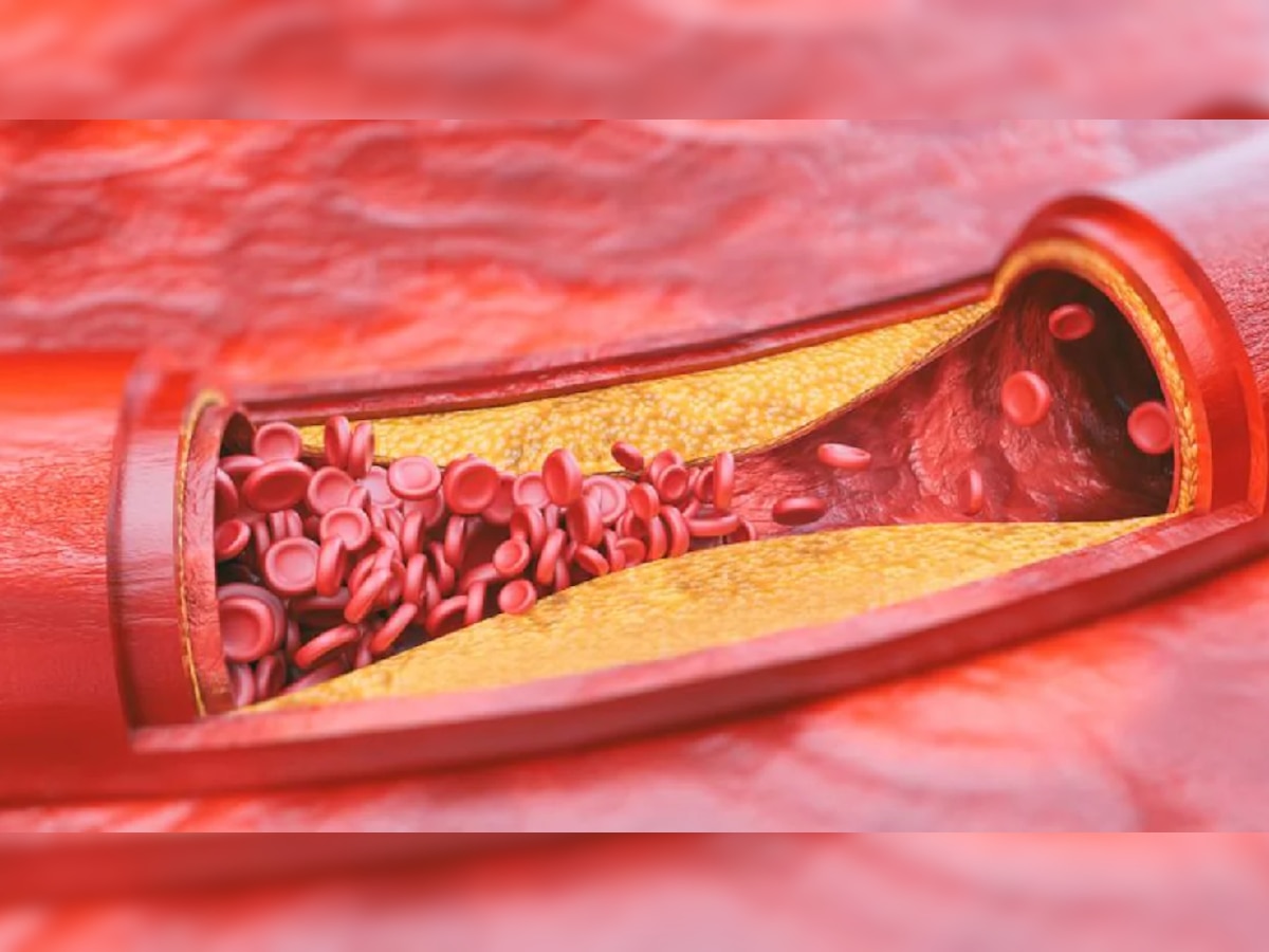 हार्ट अटॅक टाळायचा असेल तर 'या' वयापासूनच Cholesterol ची पातळी तपासणं करा सुरू title=