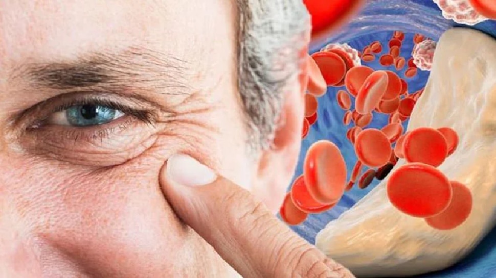 High Cholesterol Symptoms can also be seen on your face know about this