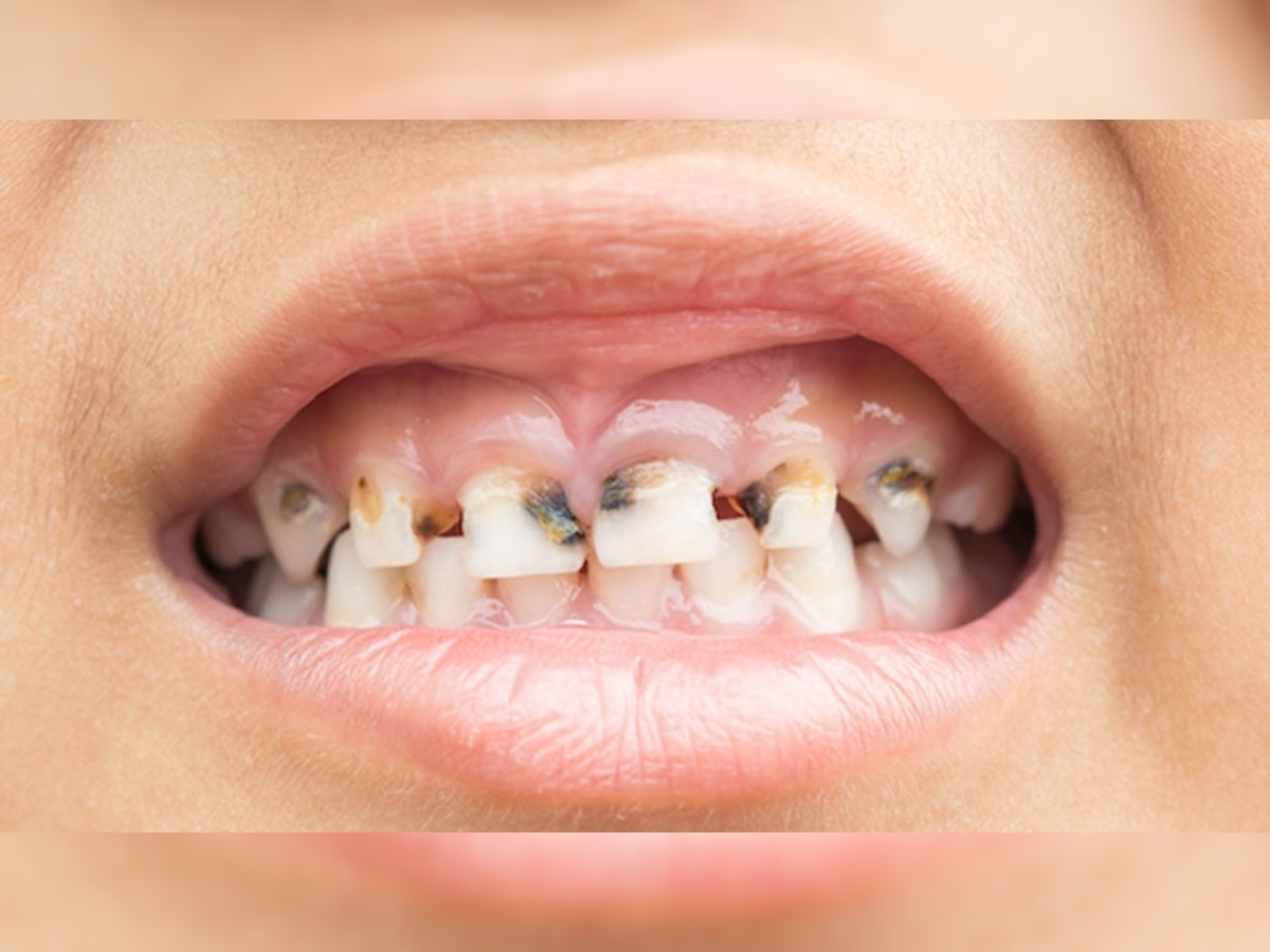 Herbal Tooth Powder: दात किडल्याची चिंता सतावतेय का? ही हर्बल पावडर घरीच बनवा आणि करा यातून सुटका  title=