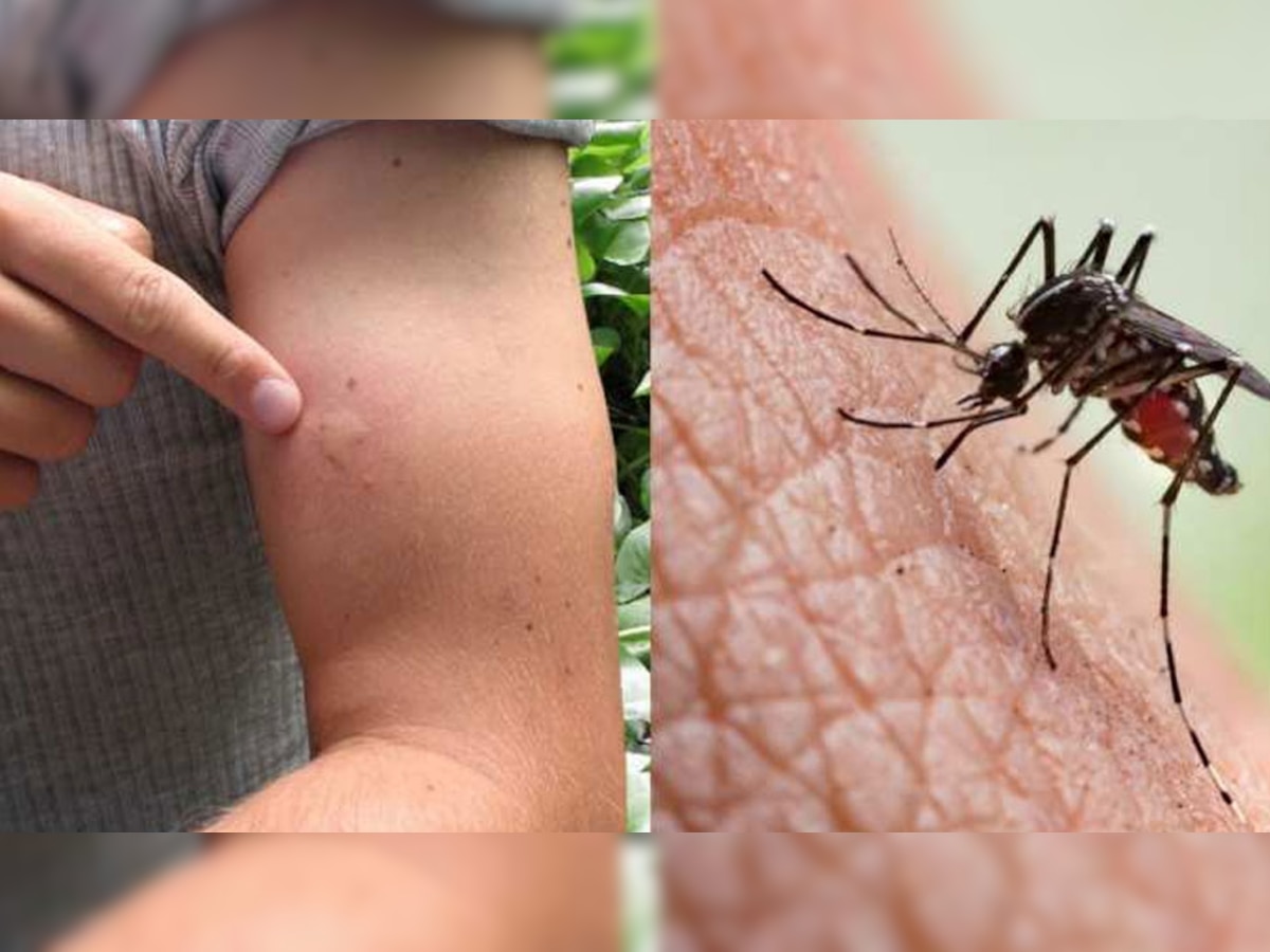 Mosquito bite : डास फक्त आपल्यालाच चावतात; असे तुम्हाला वाटते का? 'ही' आहेत त्यामागची कारणे  title=