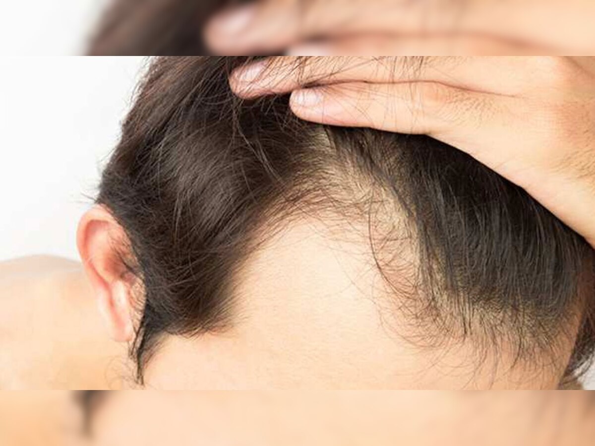 Hair Fall In Men: ...तर तुमचीही केस गळती थांबू शकेल, फक्त या गोष्टी पाळा   title=