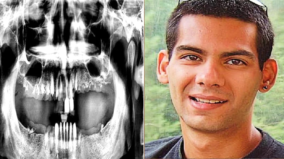 Shocking england mans teeth Suddenly fell out while eating