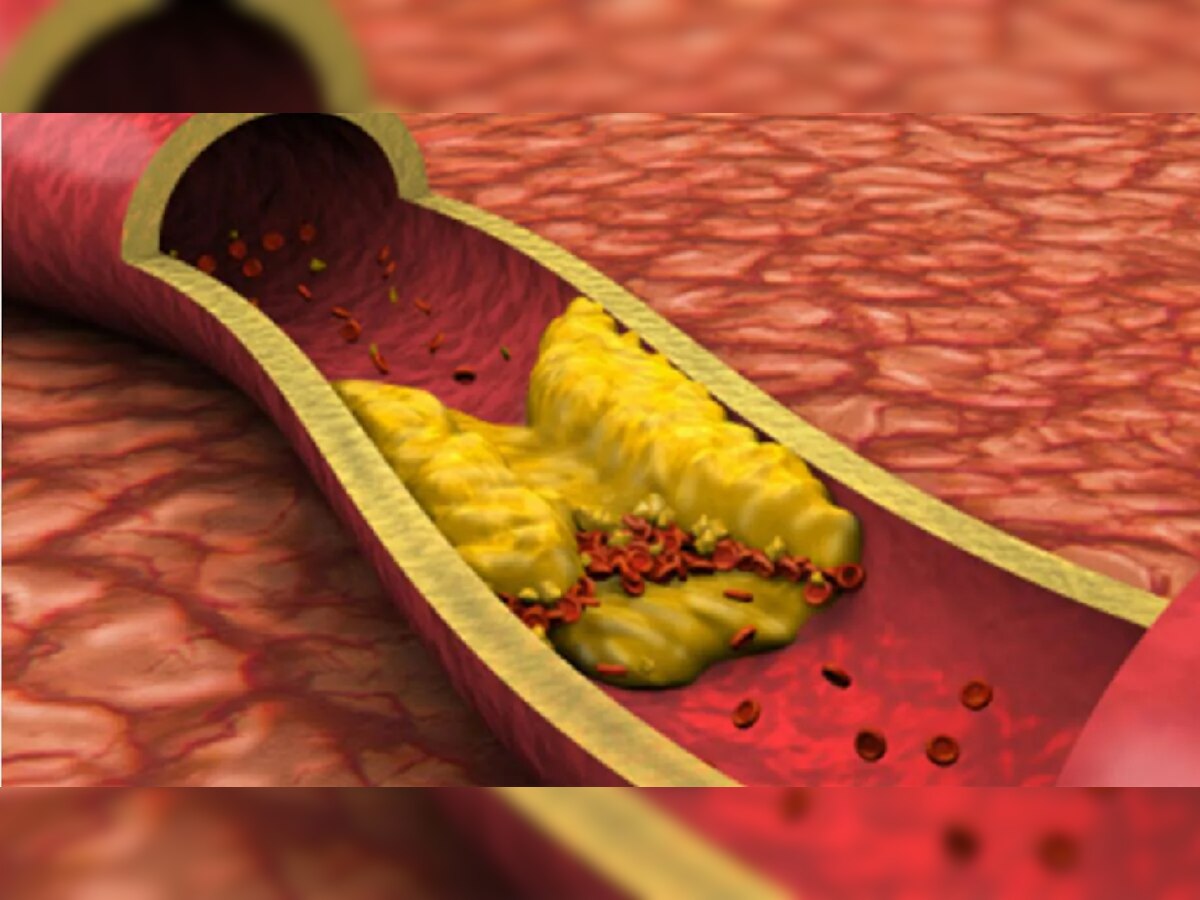 अशा 4 व्यक्तींच्या रक्तामध्ये वाढतं खराब cholesterol; आजच सावध व्हा! title=