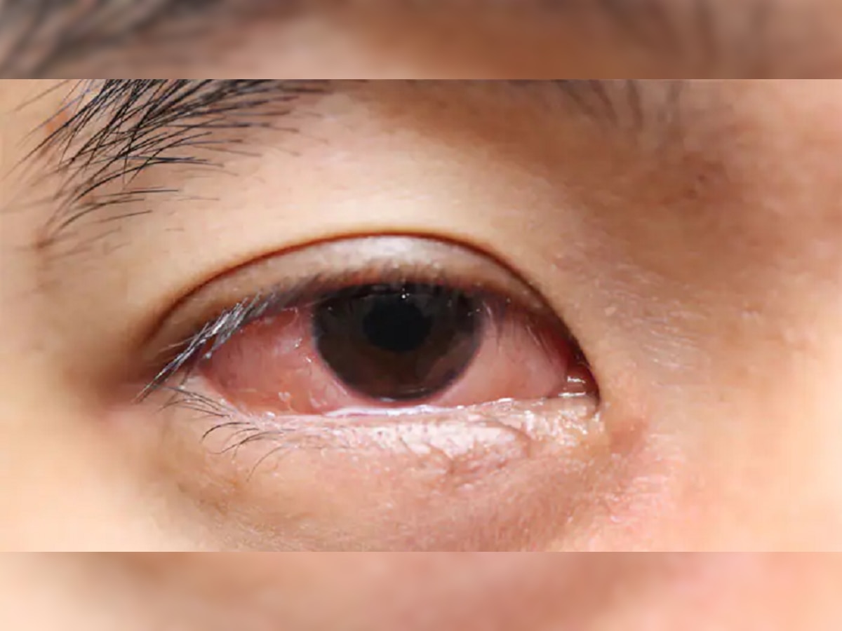 Swelling in Eyelids Causes:  तुमच्या ही पापण्या सुजतात का? जाणून घ्या कारणे आणि घरगुती उपाय... title=