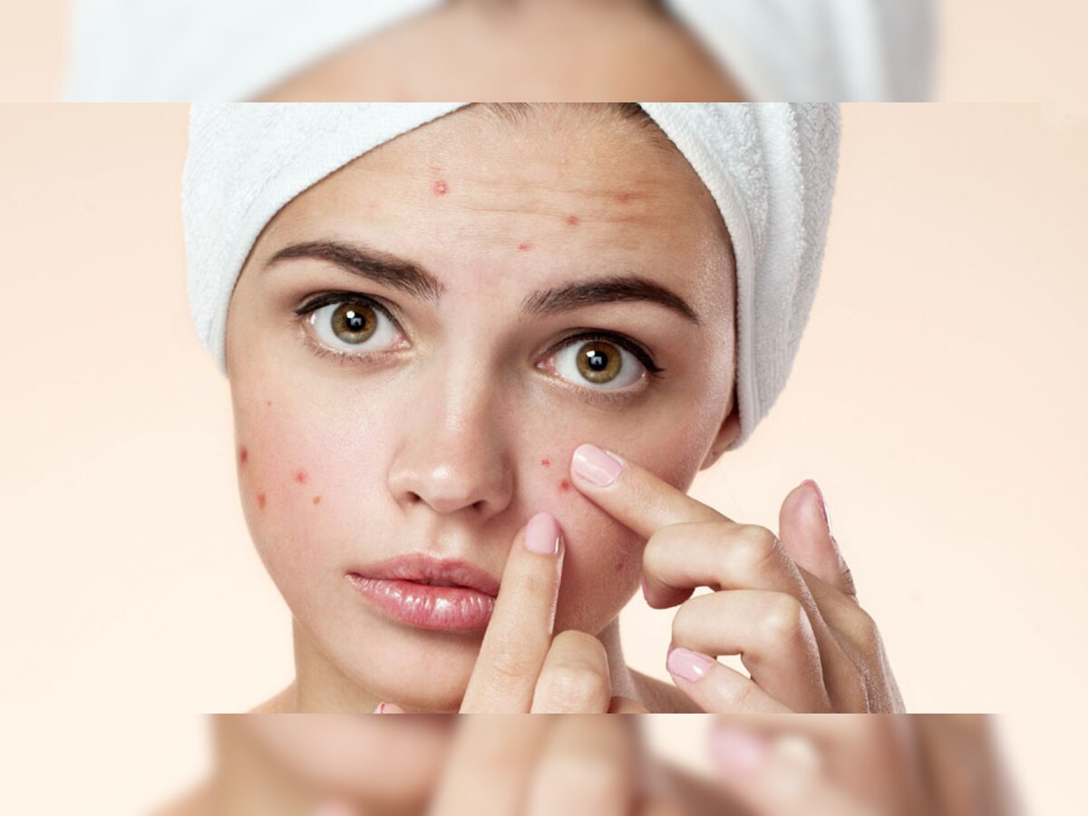 Pimples : पिंपल्सने तुम्ही त्रस्त असाल तर चुकूनही करु नका Mistakes, चेहऱ्याला पोहोचू शकते मोठे नुकसान title=