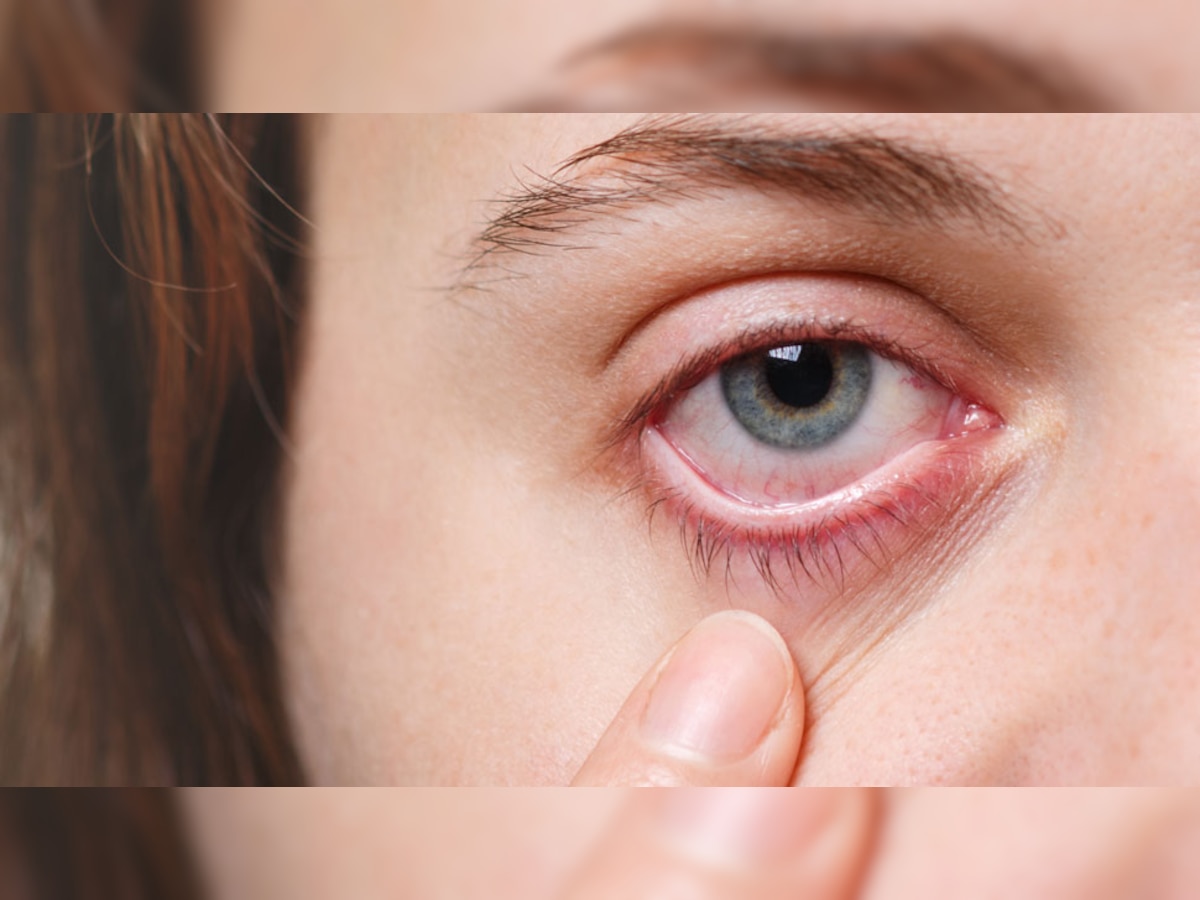 Dry Eye: डोळे कोरडे आणि निस्तेज दिसत असतील तर आताच व्हा सावधान, या मोठ्या समस्यांना द्यावे लागू शकते तोंड  title=