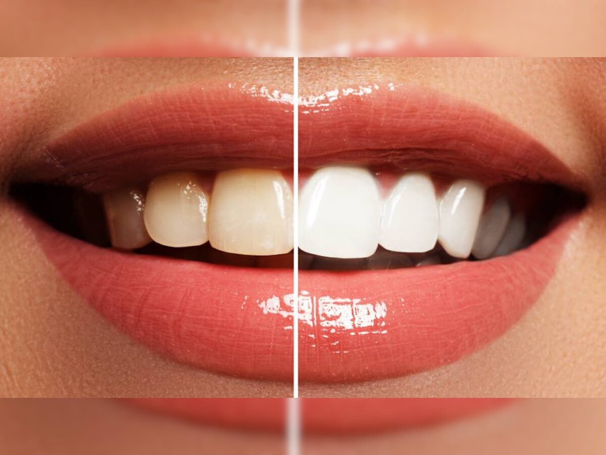 Bye Bye Yellow Teeth : या फळाच्या सालीचा वापर करून दात चमकतील मोत्यासारखे, फक्त असा करा वापर... title=