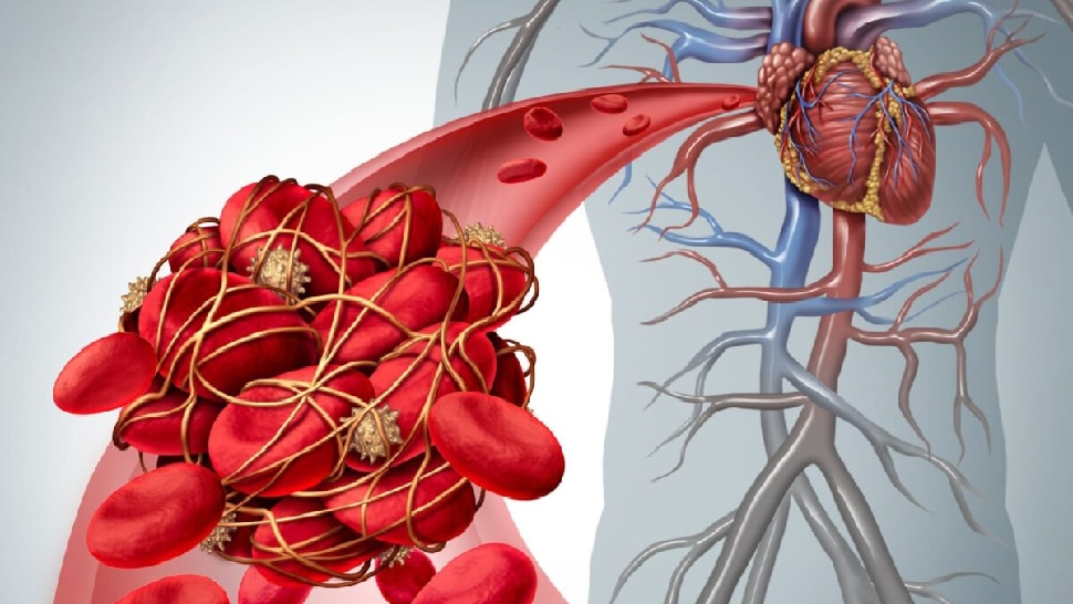 Blood clots occur heart do not ignore this symptoms