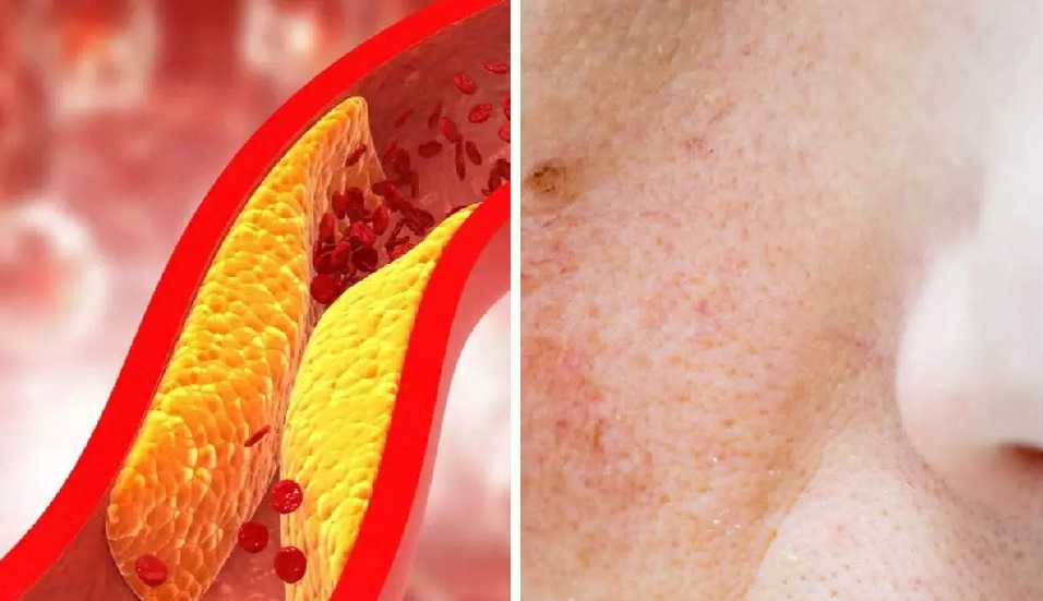 high-cholesterol-shows-on-skin-know-about-3-symptoms