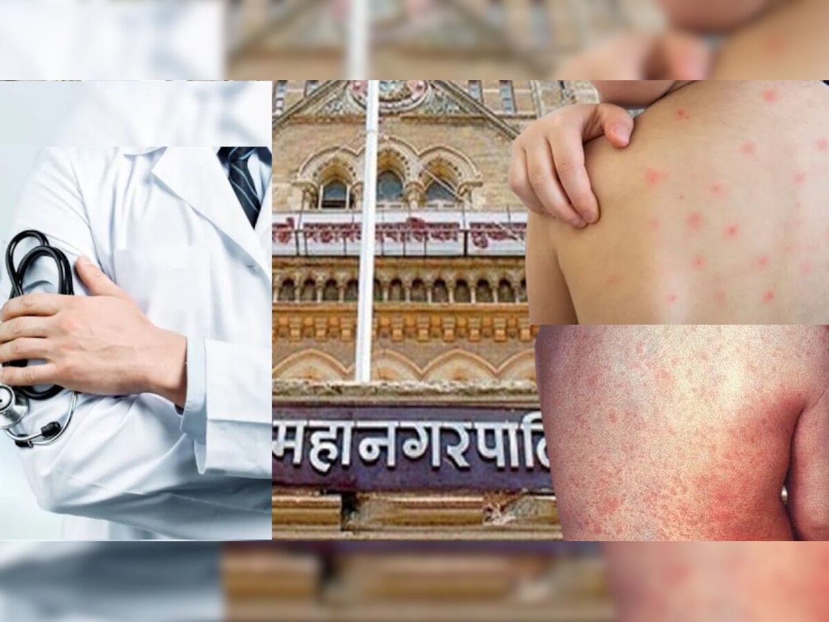 Measles outbreak  : मुंबईकरांची चिंता वाढवणारी बातमी, आतापर्यंत 'या' आजाराचे 74 रुग्ण आढळलेत title=