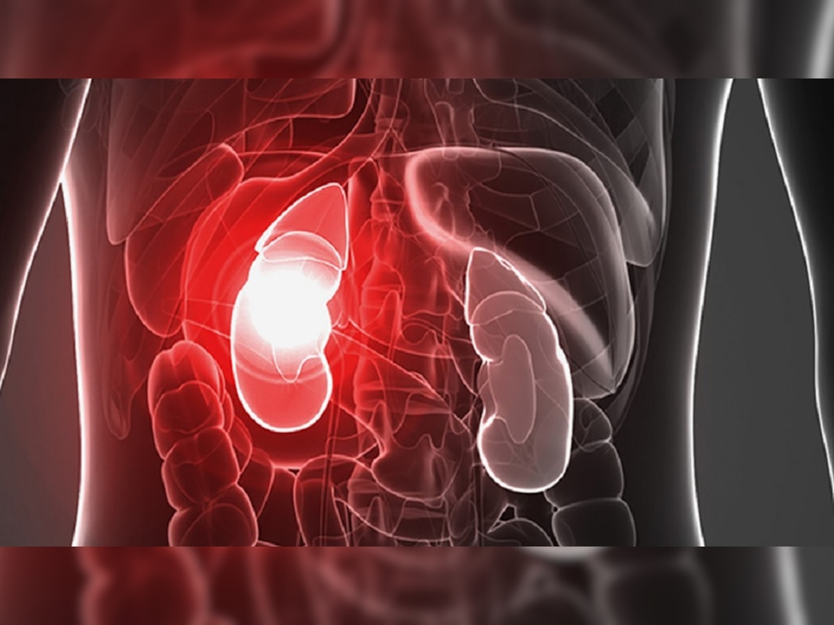 Signs of Kidney Problem : किडनी खराब होण्याची 'ही' 5 चिन्हे चुकूनही दुर्लक्ष करू नका; नाहीतर होईल हा गंभीर आजार title=