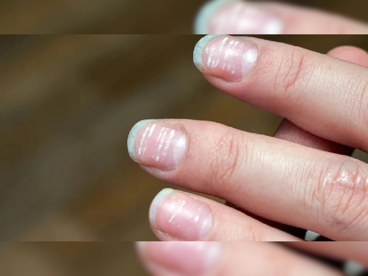 White spots on nails: नखांवर पांढरे डाग आल्यास दुर्लक्ष करु नका? या गंभीर आजाराचे देतात संकेत title=